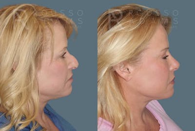 Rhinoplasty <span class=small>By Dr. Daniel Rousso</span> Before & After Gallery - Patient 160572931 - Image 1