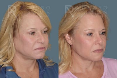 Rhinoplasty <span class=small>By Dr. Daniel Rousso</span> Before & After Gallery - Patient 160572931 - Image 2