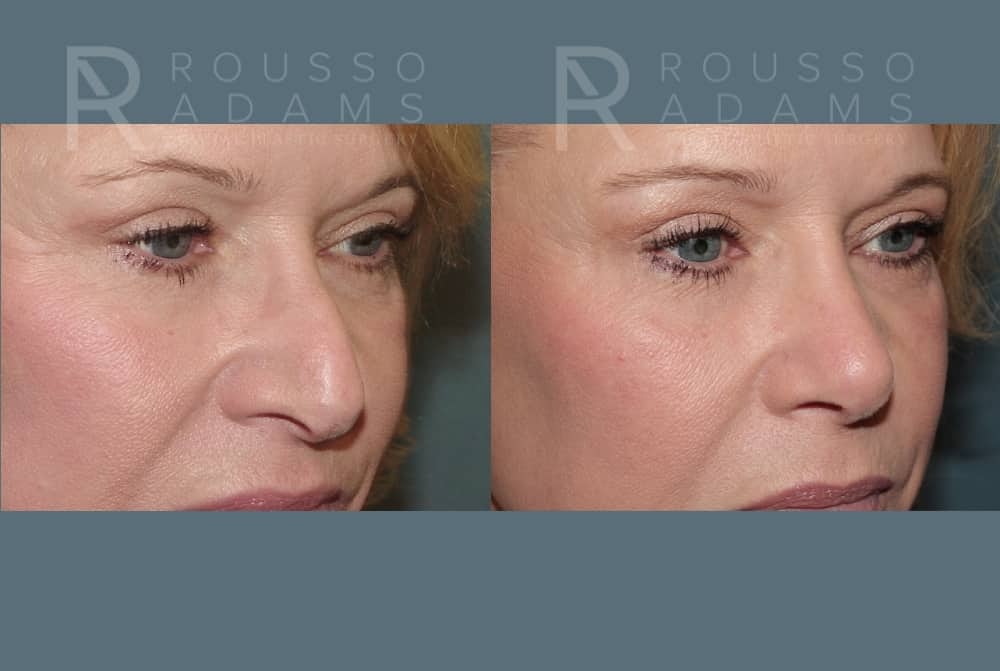 Rhinoplasty <span class=small>By Dr. Daniel Rousso</span> Before & After Gallery - Patient 160572931 - Image 3