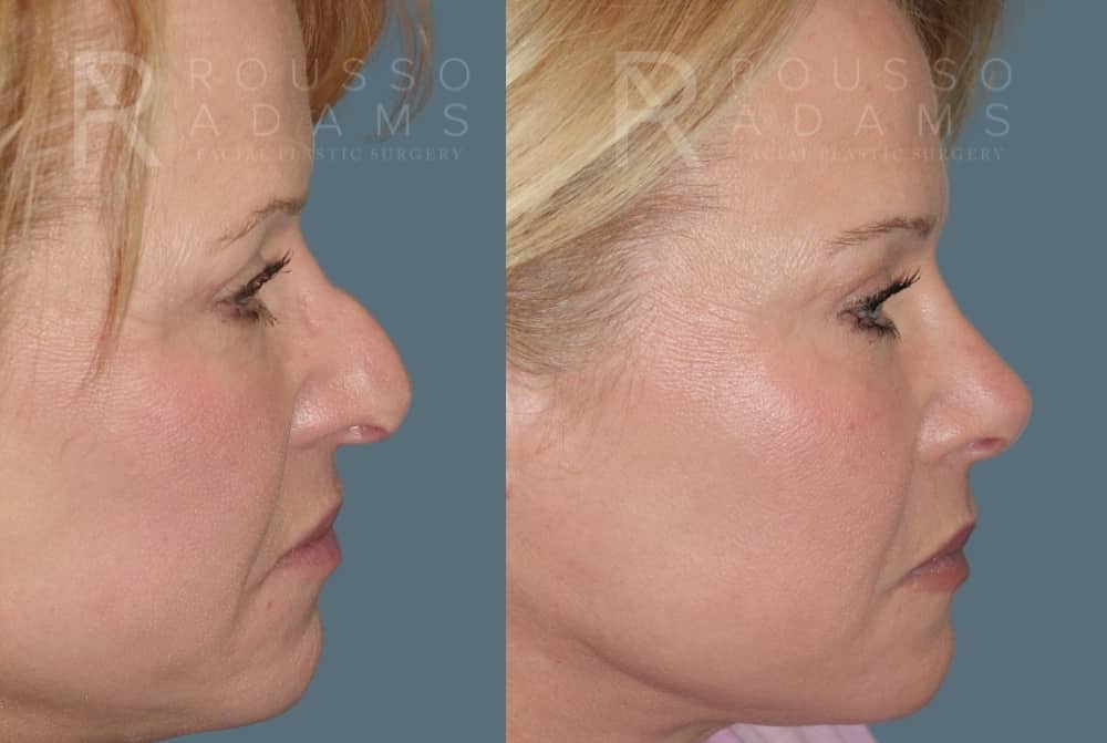 Rhinoplasty <span class=small>By Dr. Daniel Rousso</span> Before & After Gallery - Patient 160572931 - Image 5