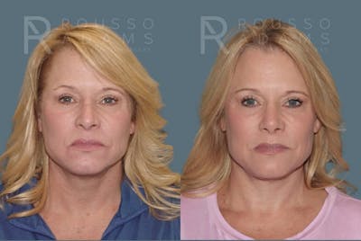 Rhinoplasty <span class=small>By Dr. Daniel Rousso</span> Before & After Gallery - Patient 160572931 - Image 6