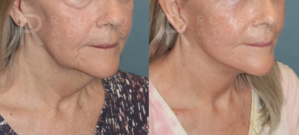 Deep Plane Facelift Before & After Gallery - Patient 174899128 - Image 1