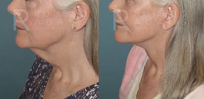 Deep Plane Facelift Before & After Gallery - Patient 174899128 - Image 2