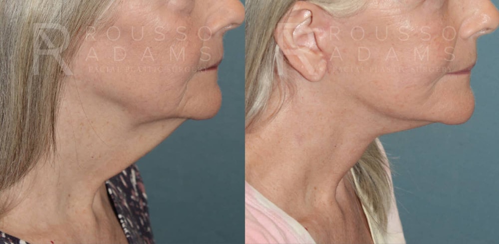 Deep Plane Facelift Before & After Gallery - Patient 174899128 - Image 3