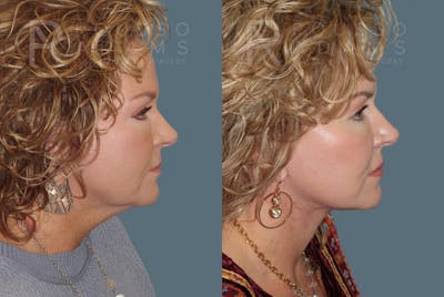 Facelift Before & After Gallery - Patient 175196818 - Image 2