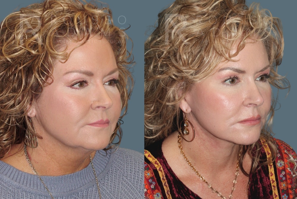 Facelift Before & After Gallery - Patient 175196818 - Image 1