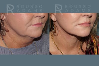 Facelift Before & After Gallery - Patient 175196818 - Image 4