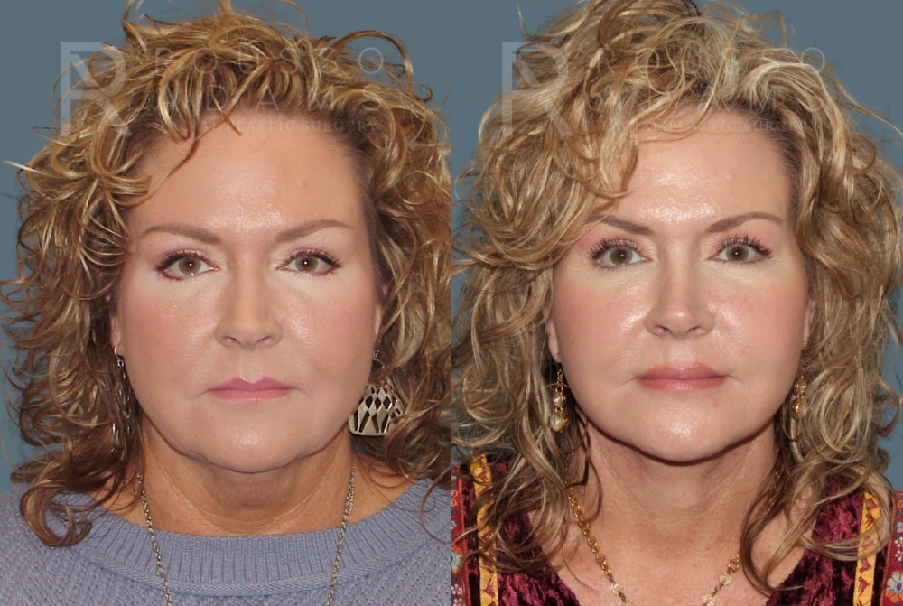 Facelift Before & After Gallery - Patient 175196818 - Image 3