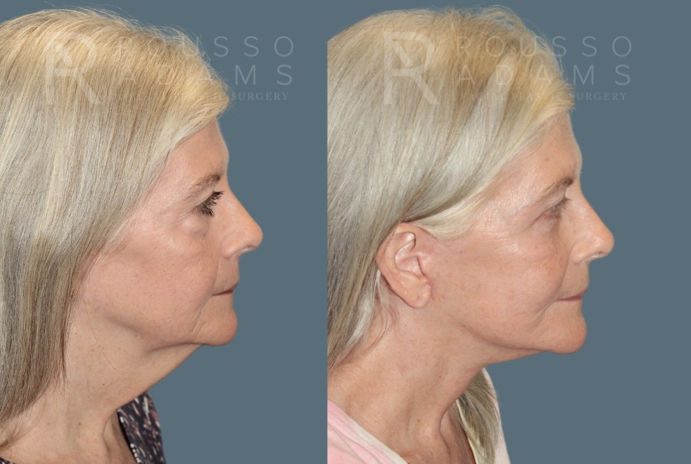 Facelift Before & After Gallery - Patient 175196821 - Image 2