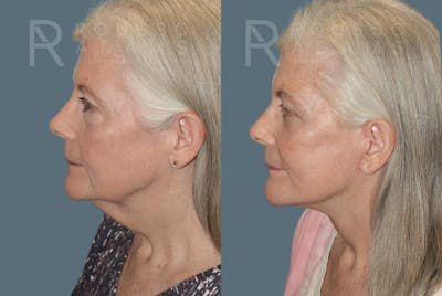 Facelift Before & After Gallery - Patient 175196821 - Image 4