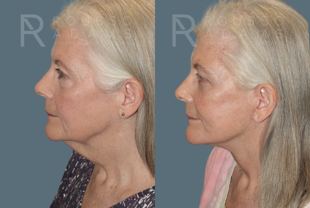 Facelift Before & After Gallery - Patient 175196821 - Image 4