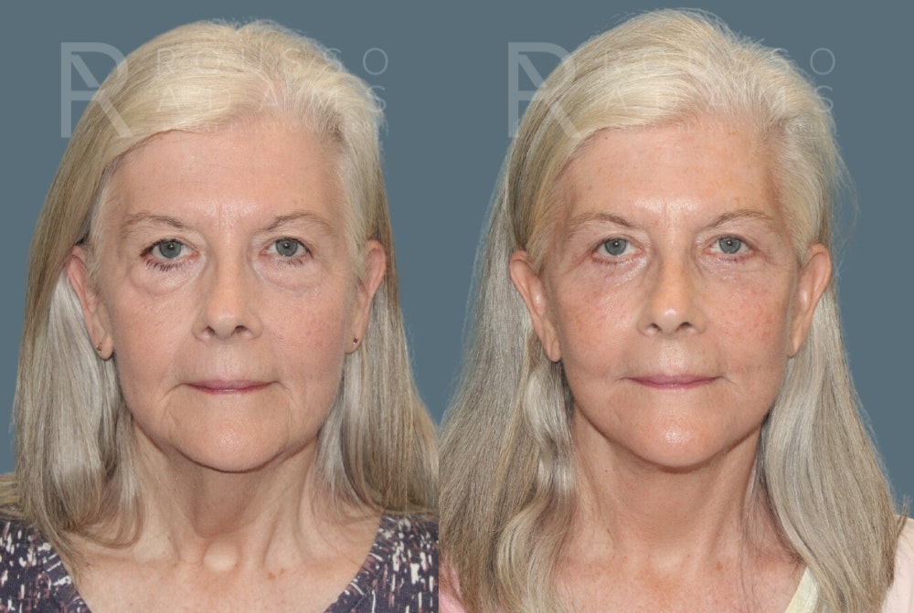 Facelift Before & After Gallery - Patient 175196821 - Image 3