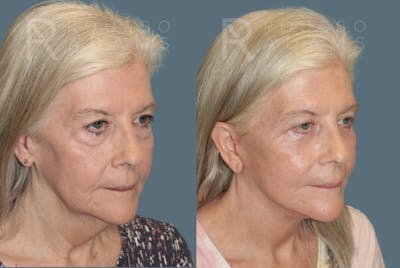 Facelift Before & After Gallery - Patient 175196821 - Image 1