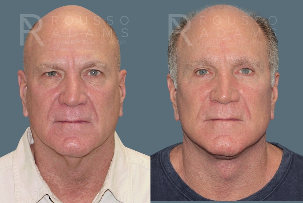 Male Facelift Before & After Gallery - Patient 175196822 - Image 3