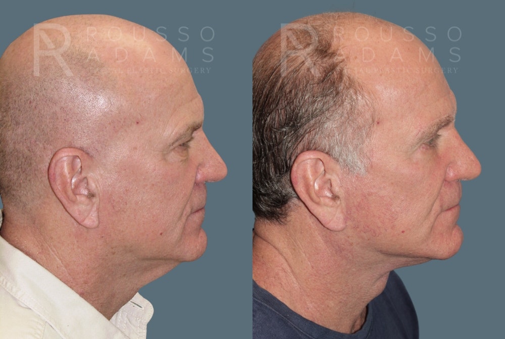 Male Facelift Before & After Gallery - Patient 175196822 - Image 2