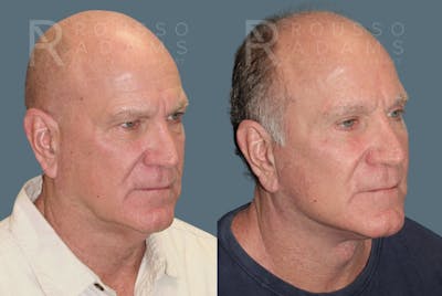 Male Facelift<span class=small>By Dr. Austin Adams</span> Before & After Gallery - Patient 175196822 - Image 1