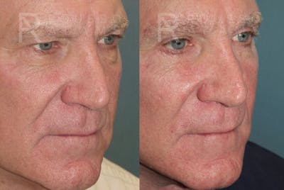 Male Facelift Before & After Gallery - Patient 175196822 - Image 4
