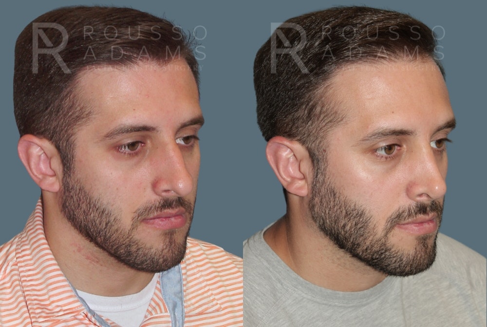 Rhinoplasty Before & After Gallery - Patient 175298217 - Image 2