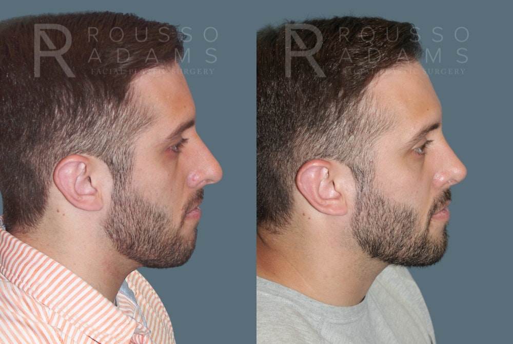 Rhinoplasty Before & After Gallery - Patient 175298217 - Image 1