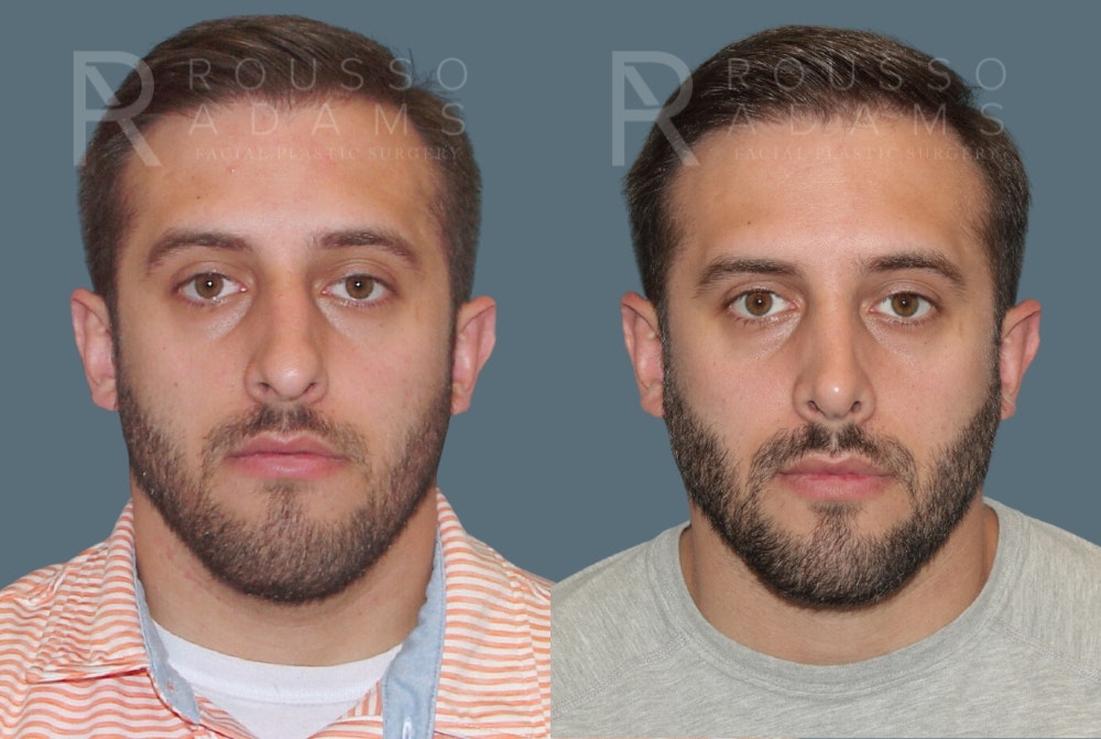 Rhinoplasty <span class=small>By Dr. Daniel Rousso</span> Before & After Gallery - Patient 175298217 - Image 3