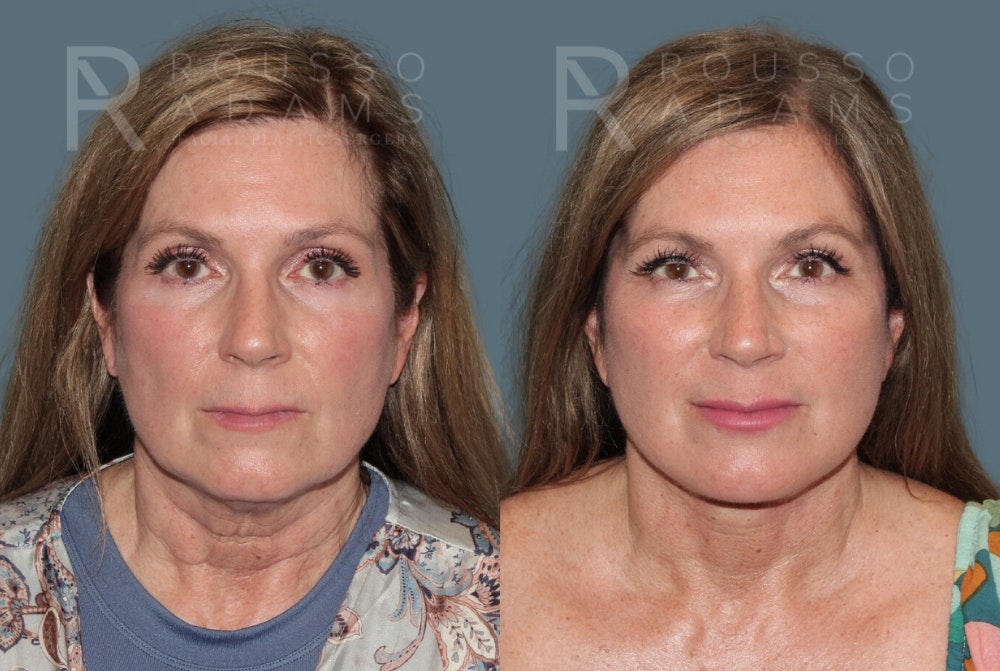 MiniLift Before & After Gallery - Patient 175298823 - Image 1