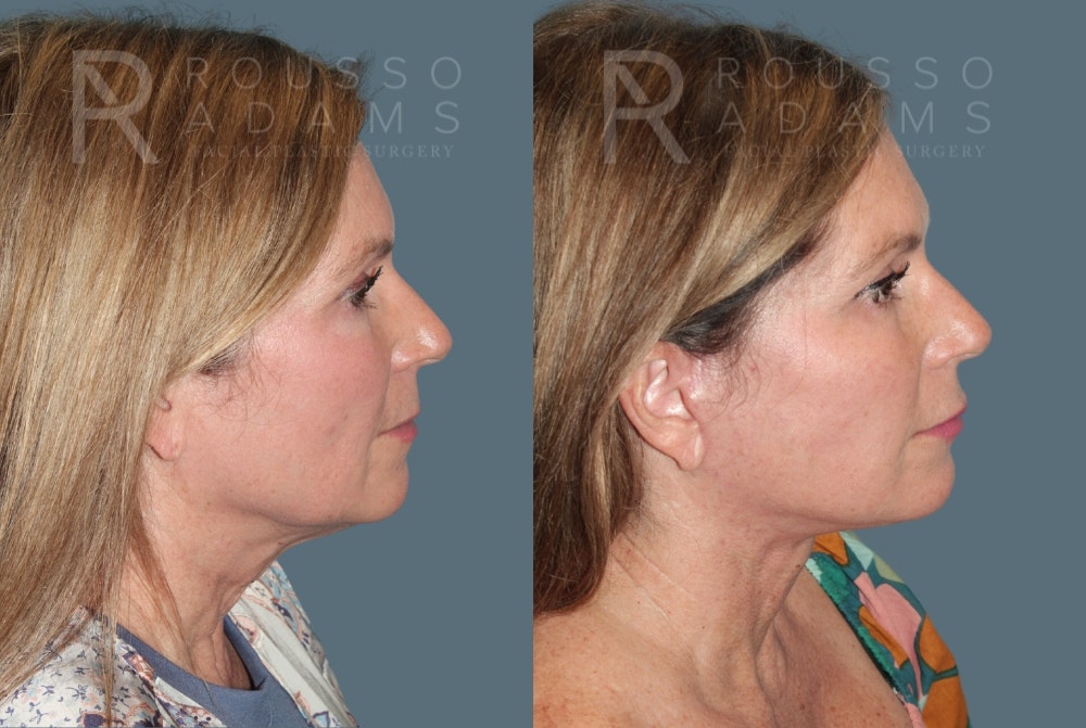 MiniLift Before & After Gallery - Patient 175298823 - Image 3