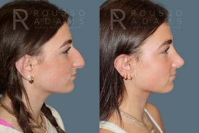 Rhinoplasty Before & After Gallery - Patient 184322481 - Image 1