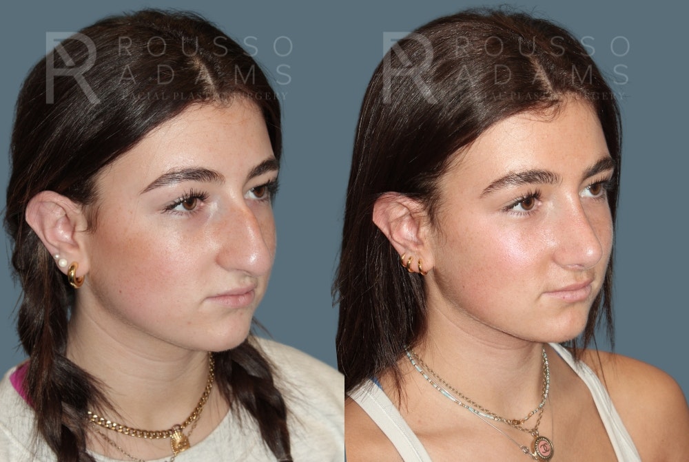 Rhinoplasty Before & After Gallery - Patient 184322481 - Image 2