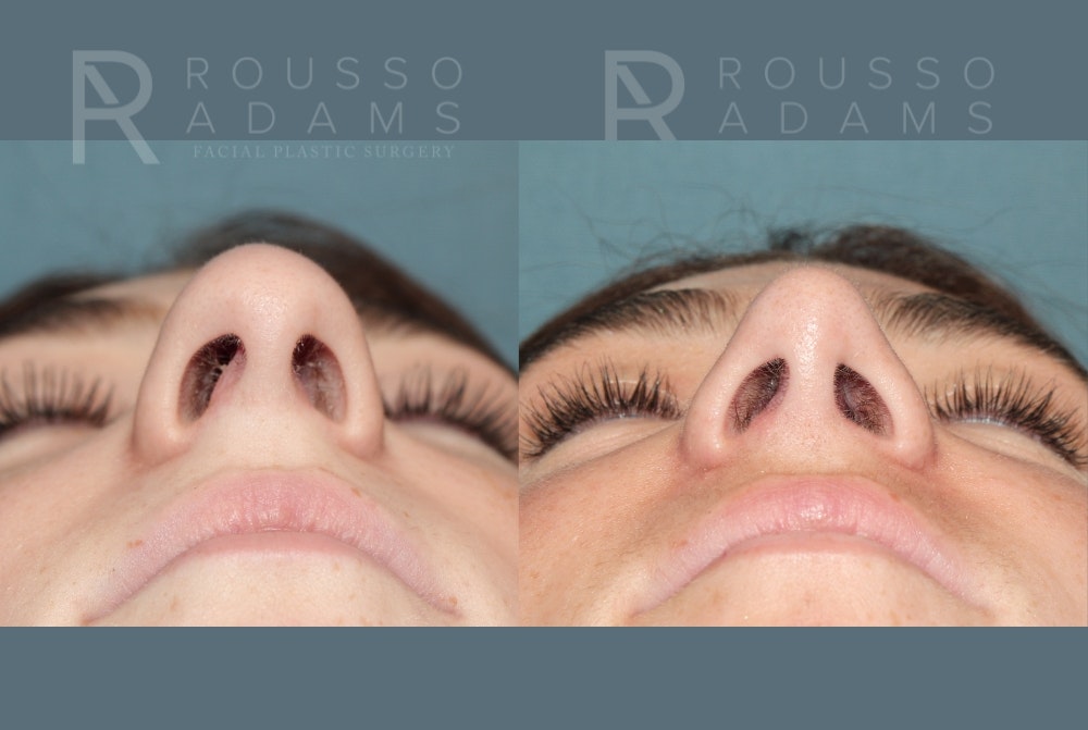 Rhinoplasty Before & After Gallery - Patient 184322481 - Image 4