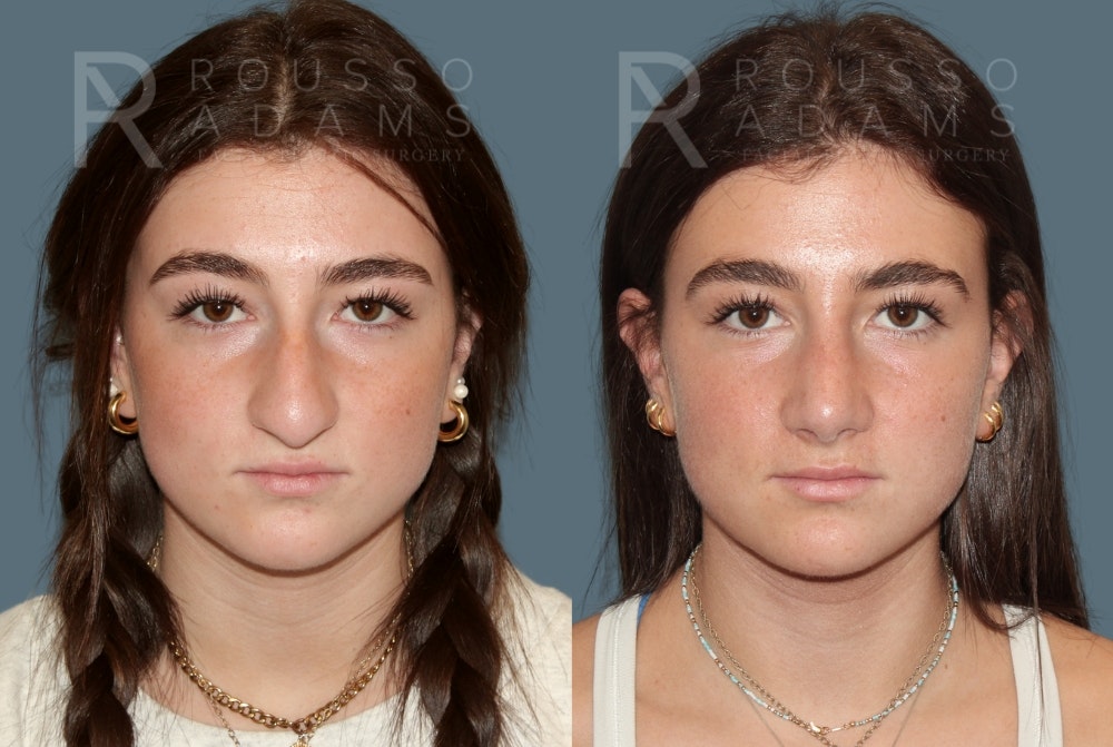 Rhinoplasty Before & After Gallery - Patient 184322481 - Image 3