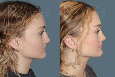 Rhinoplasty Before & After Gallery - Patient 137409 - Image 1