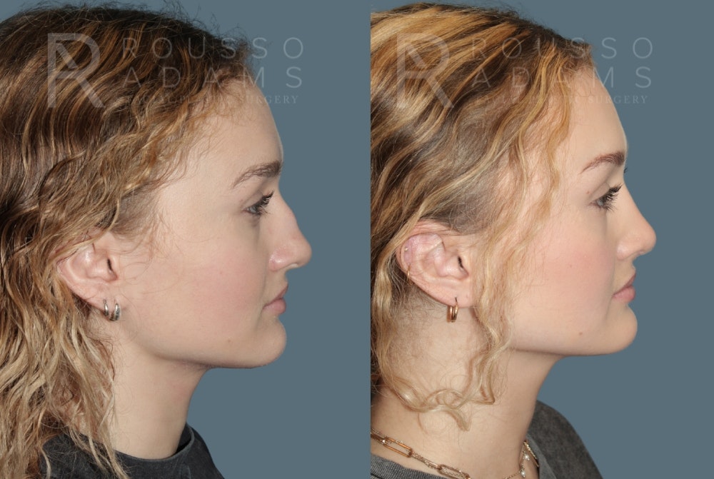 Rhinoplasty Before & After Gallery - Patient 137409 - Image 1