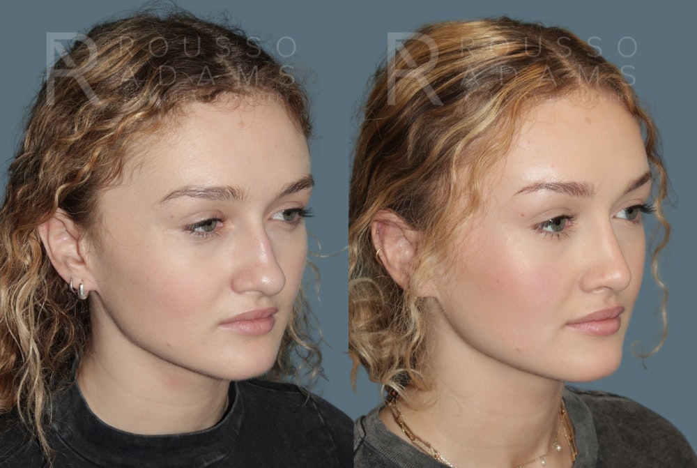 Rhinoplasty Before & After Gallery - Patient 137409 - Image 2