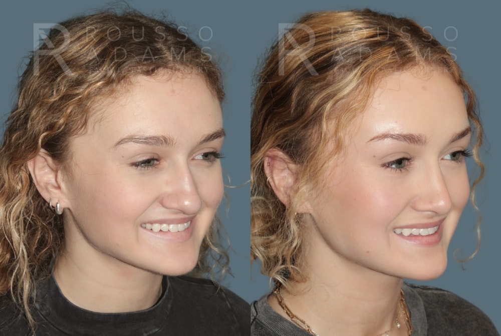 Rhinoplasty Before & After Gallery - Patient 137409 - Image 3