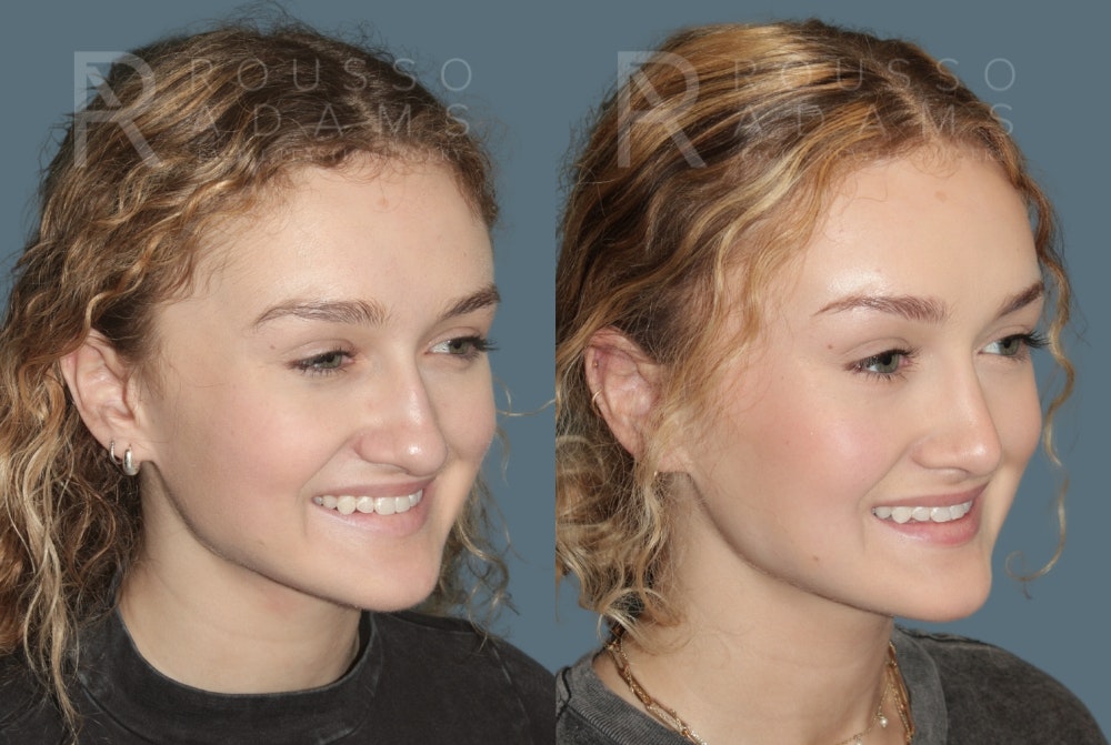Rhinoplasty Before & After Gallery - Patient 137409 - Image 3