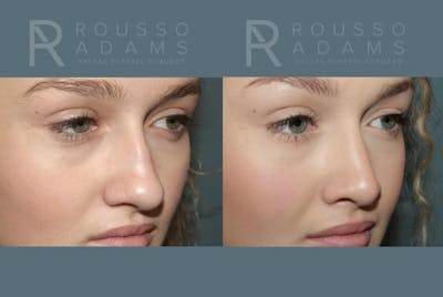 Rhinoplasty Before & After Gallery - Patient 137409 - Image 4