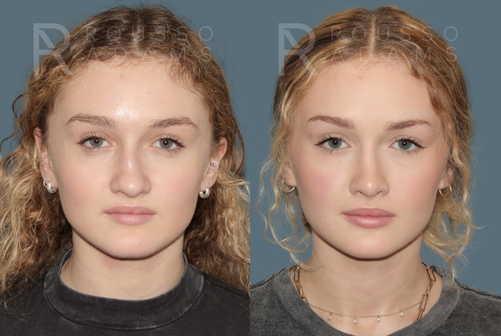 Rhinoplasty Before & After Gallery - Patient 137409 - Image 5