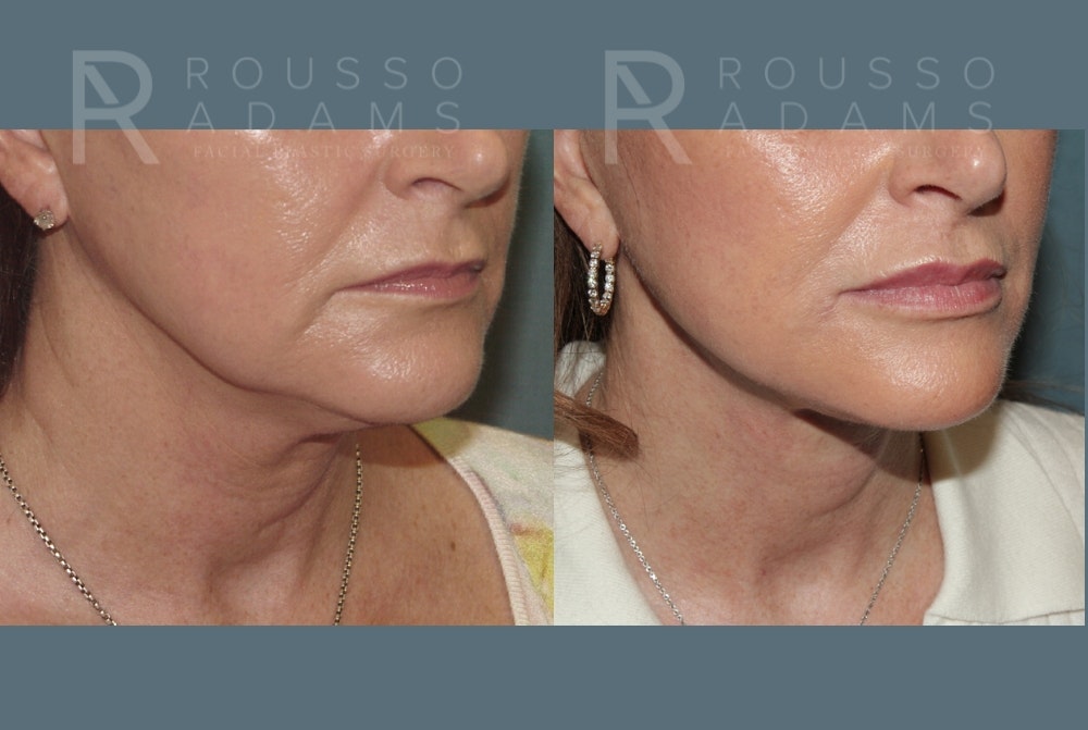 Deep Plane Facelift Before & After Gallery - Patient 390790 - Image 1