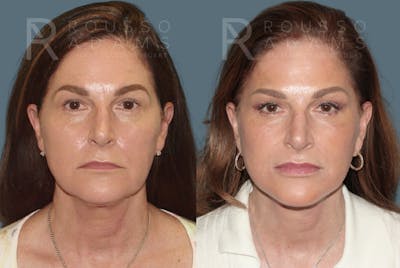 Deep Plane Facelift Before & After Gallery - Patient 390790 - Image 2