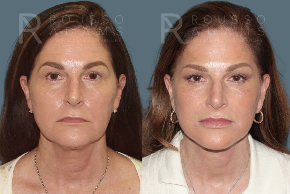 Deep Plane Facelift Before & After Gallery - Patient 390790 - Image 2
