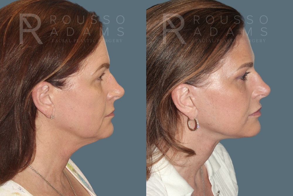 Deep Plane Facelift Before & After Gallery - Patient 390790 - Image 3