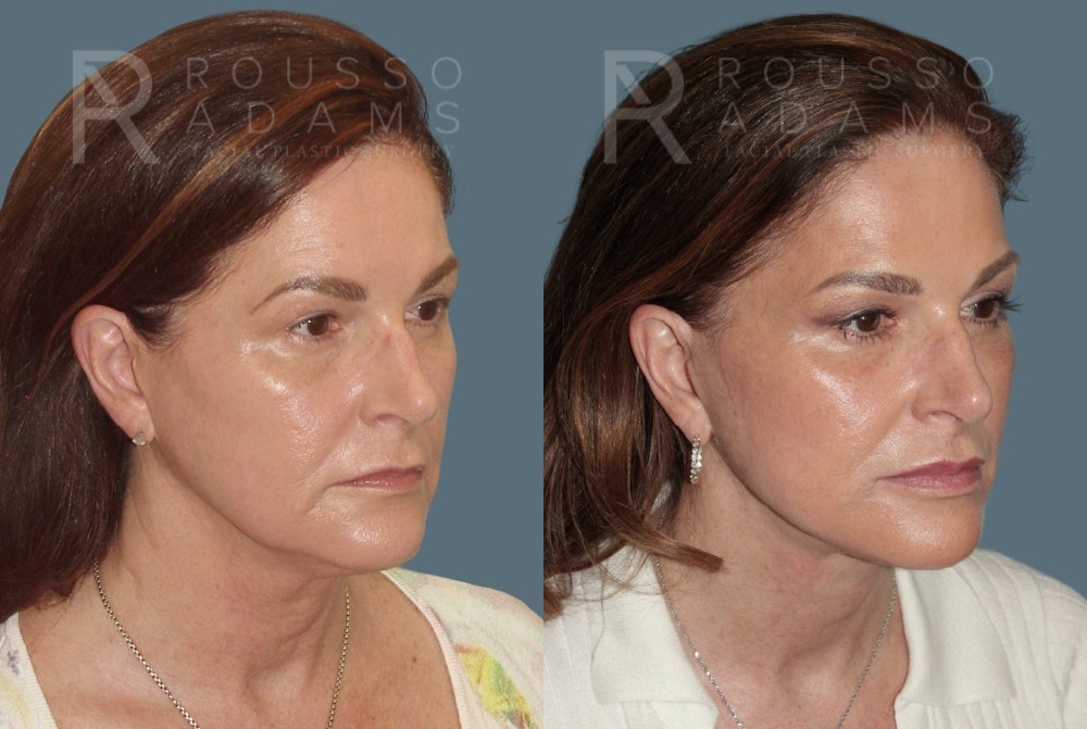 Deep Plane Facelift Before & After Gallery - Patient 390790 - Image 4