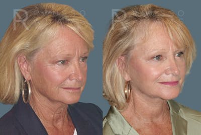 Deep Plane Facelift Before & After Gallery - Patient 407701 - Image 1