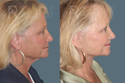 Deep Plane Facelift Before & After Gallery - Patient 407701 - Image 2