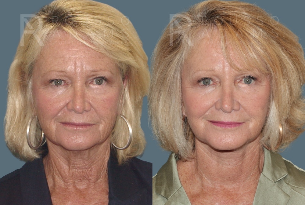 Deep Plane Facelift Before & After Gallery - Patient 407701 - Image 3