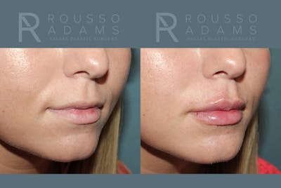 Lip Enhancement Before & After Gallery - Patient 195963 - Image 2