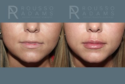 Lip Enhancement Before & After Gallery - Patient 195963 - Image 1