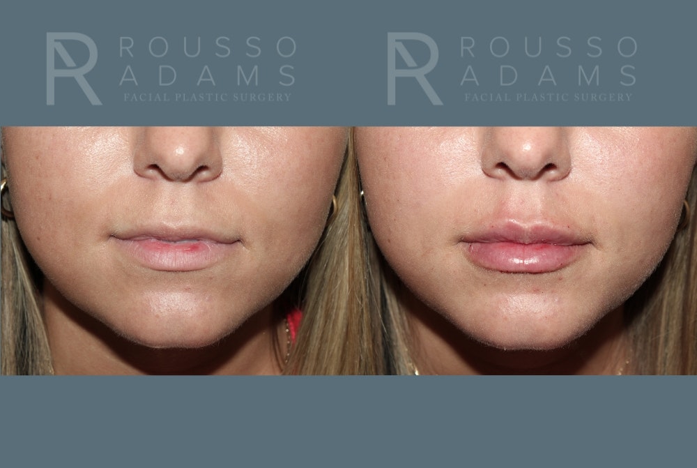 Lip Enhancement Before & After Gallery - Patient 195963 - Image 1