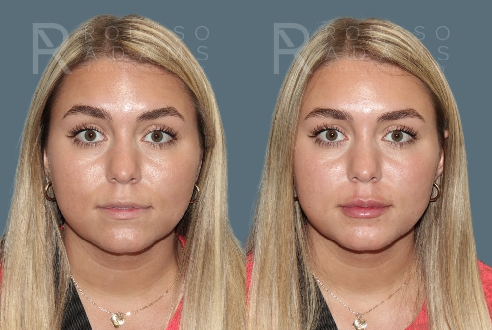 Lip Enhancement Before & After Gallery - Patient 195963 - Image 3