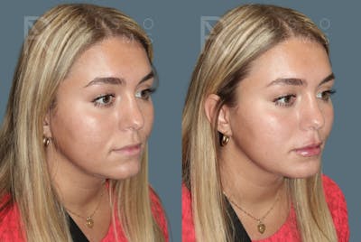 Lip Enhancement Before & After Gallery - Patient 195963 - Image 4